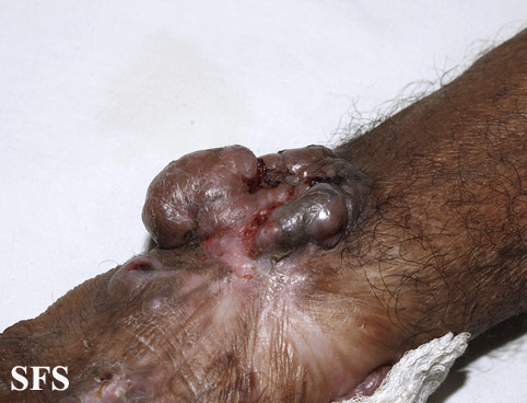 File:Melanoma (Dermatology Atlas 46).jpg