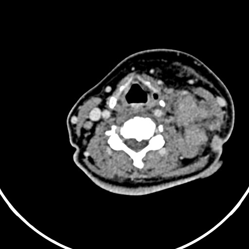 Nasopharyngeal carcinoma- T4,N3b (Radiopaedia 59376-66738 B 81).jpg