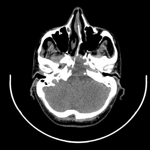 File:Nasopharyngeal carcinoma - infiltrating the clivus (Radiopaedia 62583-70875 Axial non-contrast 11).jpg