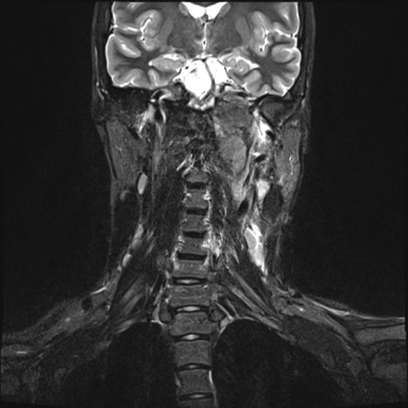 Nasopharyngeal carcinoma with skull base invasion (Radiopaedia 53415-59485 Coronal T2 fat sat 15).jpg