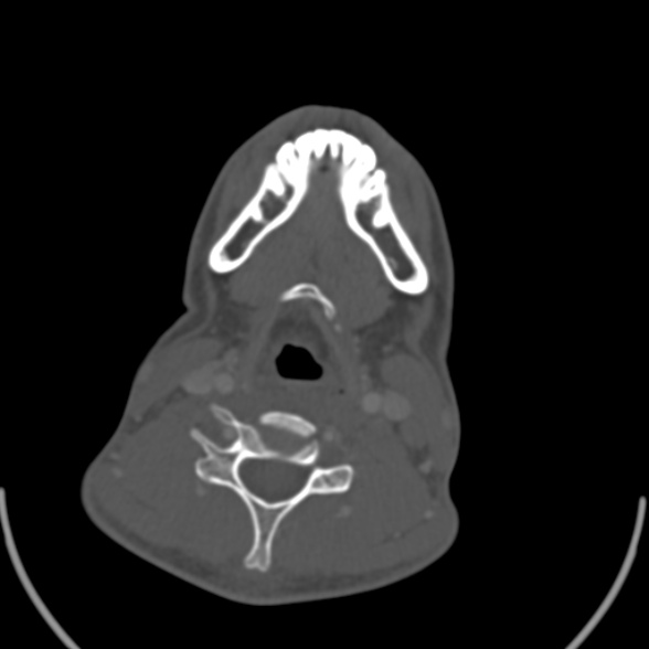 Nasopharyngeal carcinoma with skull base invasion (Radiopaedia 53415-59705 Axial bone window 136).jpg