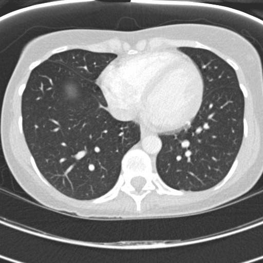 File:Necrobiotic pulmonary nodules - Crohn disease (Radiopaedia 20723-20631 Axial lung window 100).jpg