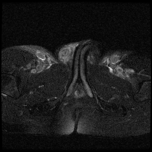 File:Necrotizing epididymo-orchitis with intra-testicular abscess (Radiopaedia 29397-29860 Axial T2 fat sat 9).jpg