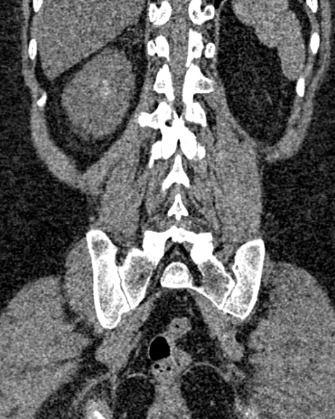 File:Nephrostomy for urosepsis (Radiopaedia 26180-26330 non-contrast 69).jpg