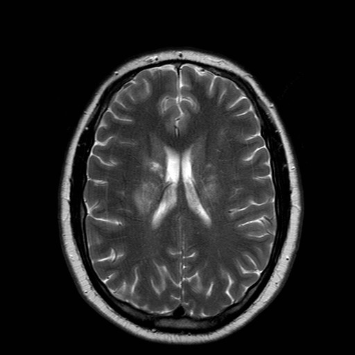 File:Neuro-Behcet's disease (Radiopaedia 21557-21505 Axial T2 14).jpg