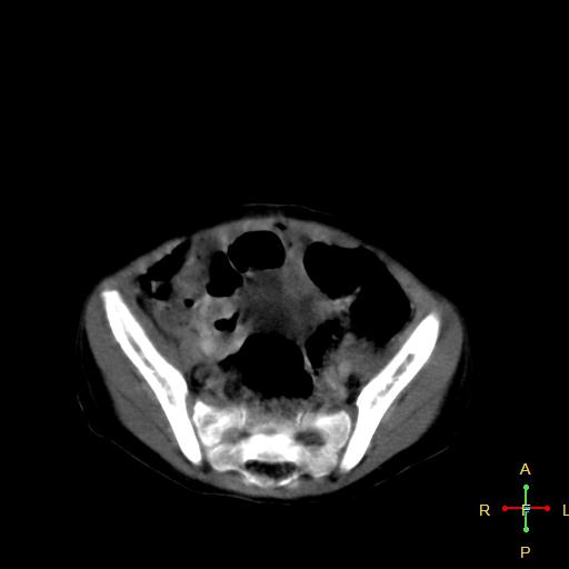 File:Neuroblastoma (Radiopaedia 24751-25016 D 34).jpg