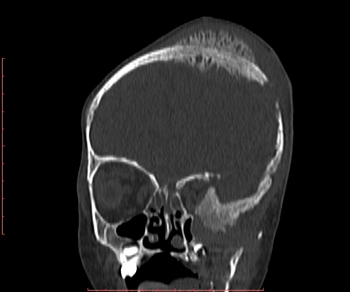 File:Neuroblastoma skull metastasis (Radiopaedia 56053-62683 Coronal bone window 11).jpg