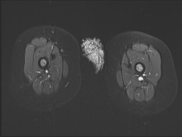 File:Neuroblastoma with bone metastases (Radiopaedia 67080-76414 Axial STIR 29).jpg