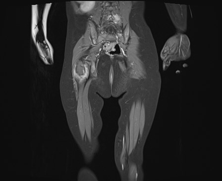 File:Neuroblastoma with bone metastases (Radiopaedia 67080-76414 E 20).jpg