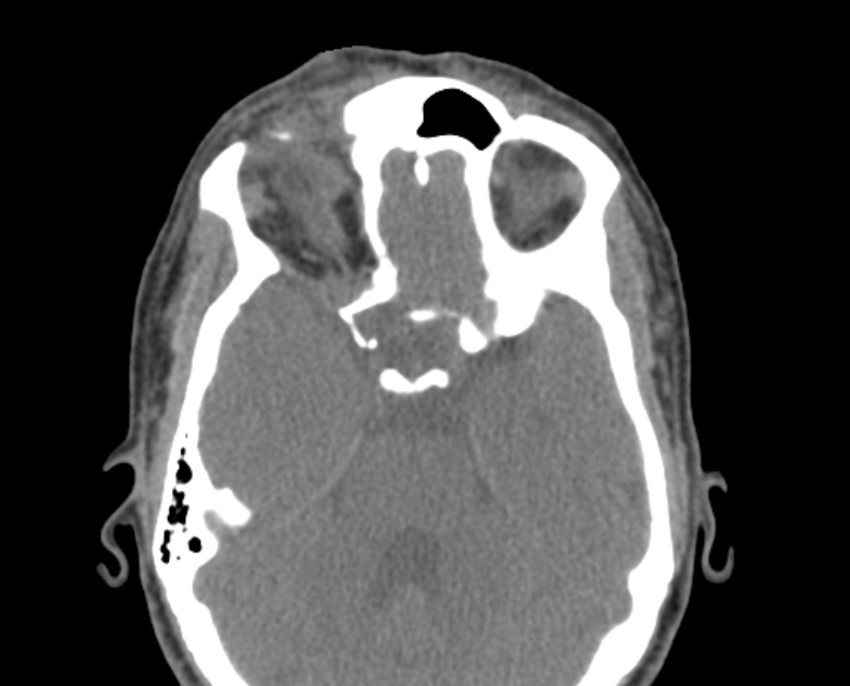 Neurofibromatosis type 1- orbital manifestations (Radiopaedia 49391-54511 Axial non-contrast 58).jpg