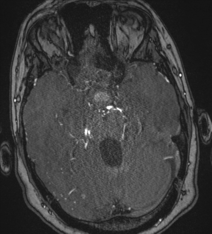 Neurofibromatosis type 1 - head and neck - CNS manifestations (Radiopaedia 49910-55188 Axial MRA 28).png