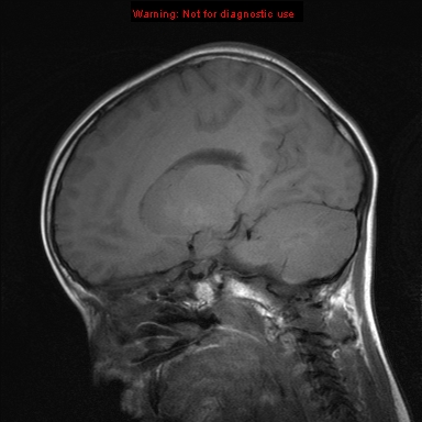 File:Neurofibromatosis type 1 with optic nerve glioma (Radiopaedia 16288-15965 Sagittal T1 10).jpg