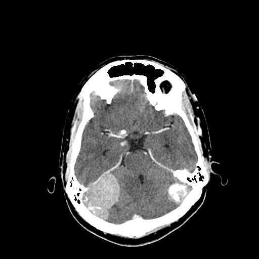 File:Neurofibromatosis type 2 (Radiopaedia 25389-25637 Axial C+ 25).jpg