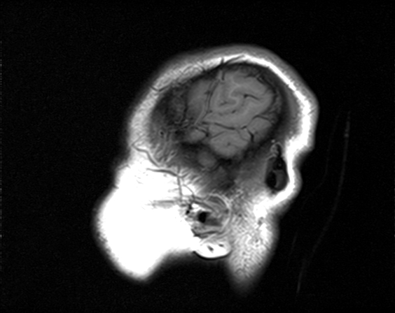 File:Neurofibromatosis type 2 (Radiopaedia 66211-75401 Sagittal T1 24).jpg