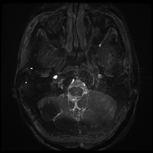 Neurofibromatosis type 2 - bilateral acoustic neuromata (Radiopaedia 40060-42566 Axial FIESTA 4).png