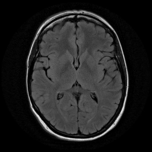 File:Neurofibromatosis type 2 - bilateral acoustic neuromata (Radiopaedia 40060-42566 Axial FLAIR 11).png