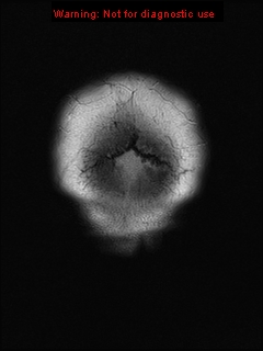 File:Neuroglial cyst (Radiopaedia 10713-11184 Coronal FLAIR 1).jpg