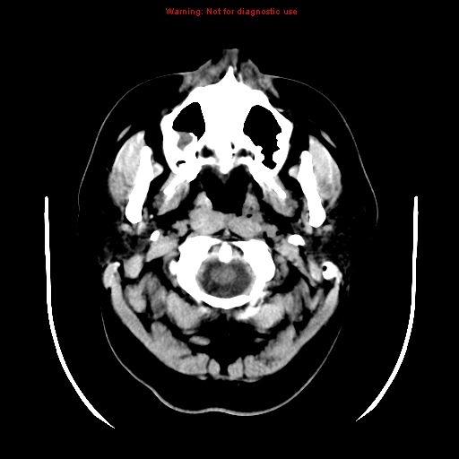 File:Neuroglial cyst (Radiopaedia 10713-11185 Axial non-contrast 31).jpg