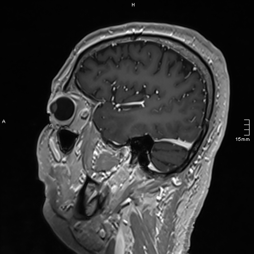 Neurosarcoidosis - involvement of the mesial temporal lobes (Radiopaedia 67429-76820 Sagittal T1 C+ 43).jpg