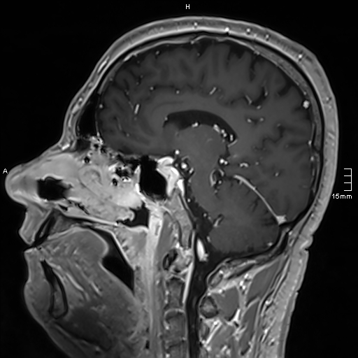 Neurosarcoidosis - involvement of the mesial temporal lobes (Radiopaedia 67429-76820 Sagittal T1 C+ 76).jpg