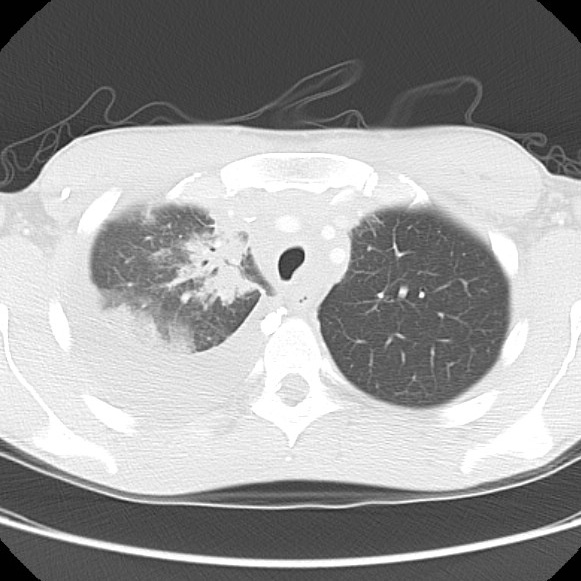 File:Non-Hodgkin lymphoma involving lung (Radiopaedia 29094-29470 Axial lung window 19).jpg