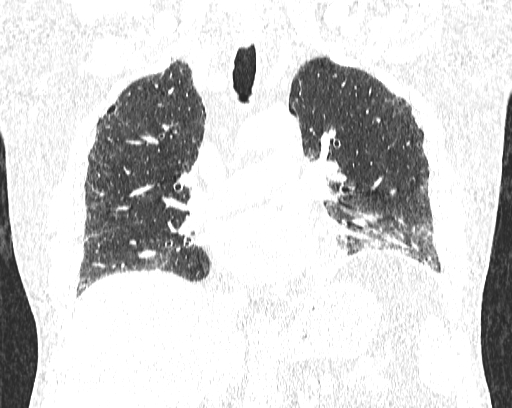 Non-specific interstitial pneumonia (NSIP) (Radiopaedia 68599-78228 Coronal lung window 46).jpg