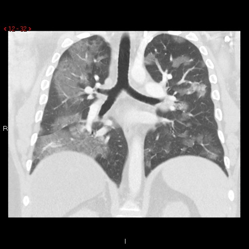 File:Non-specific interstitial pneumonitis (Radiopaedia 27044-27222 Coronal lung window 32).jpg