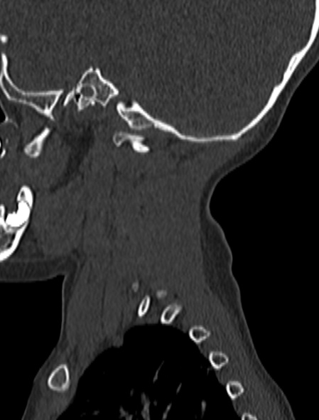 Normal CT cervical spine - pediatric (Radiopaedia 52549-58462 Sagittal bone window 202).jpg