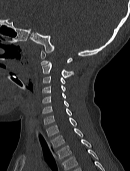File:Normal CT cervical spine - pediatric (Radiopaedia 52549-58462 Sagittal bone window 76).jpg