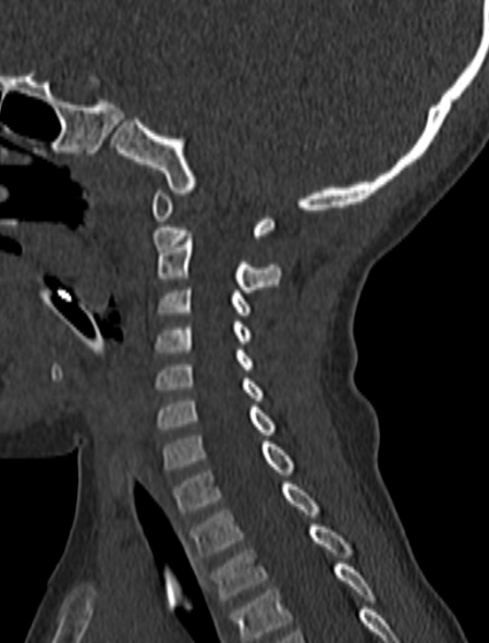 File:Normal CT cervical spine - pediatric (Radiopaedia 52549-58462 Sagittal bone window 81).jpg