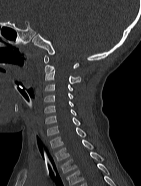 Normal CT cervical spine - pediatric (Radiopaedia 52549-58462 Sagittal bone window 85).jpg