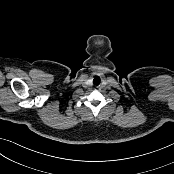 Normal CT chest- adult female (Radiopaedia 52522-58428 Axial non-contrast 1).jpg