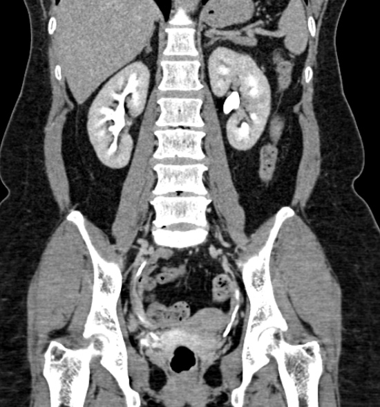 Normal CT intravenous urogram (Radiopaedia 39444-41759 A 298).jpg