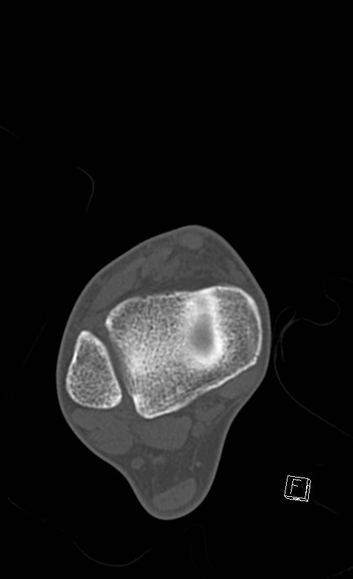 Normal CT of the ankle (Radiopaedia 47111-51658 Axial bone window 35).jpg