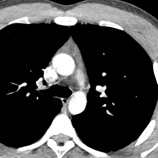 File:Normal CT pulmonary veins (pre RF ablation) (Radiopaedia 41748-44702 A 33).png