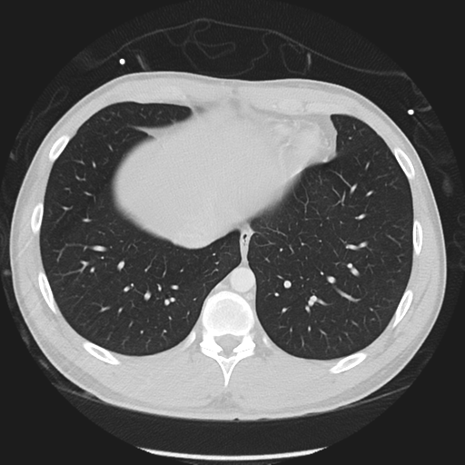 Normal CT pulmonary veins (pre RF ablation) (Radiopaedia 41748-44702 Axial lung window 51).png