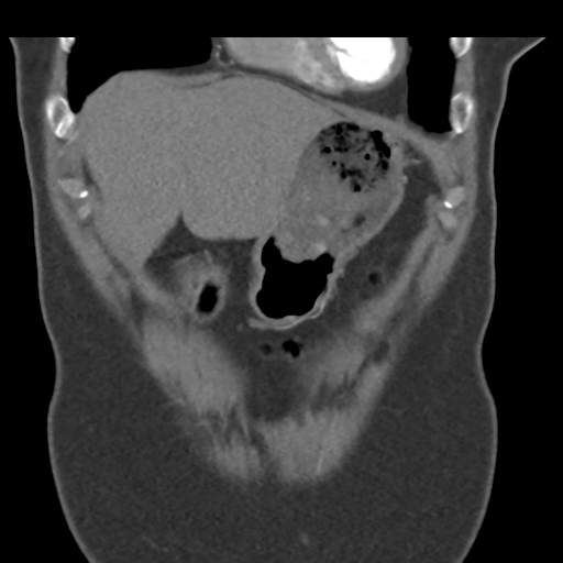 File:Normal CT renal artery angiogram (Radiopaedia 38727-40889 B 15).png