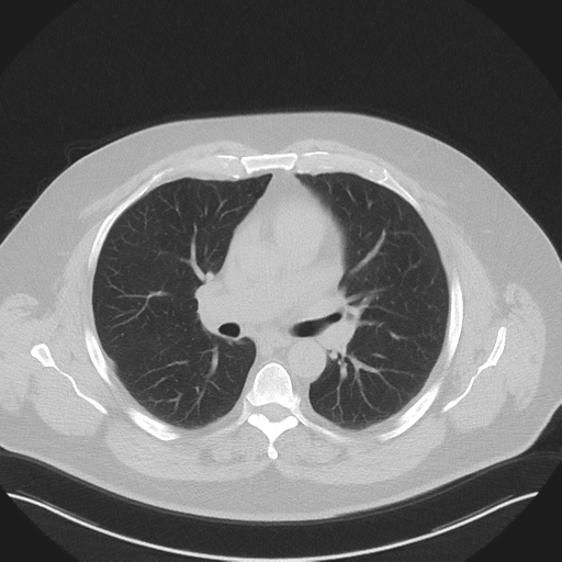 Normal HRCT (Radiopaedia 40797-43458 Axial lung window 27).png
