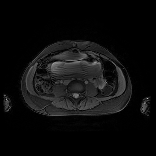 File:Normal MRI abdomen in pregnancy (Radiopaedia 88001-104541 D 32).jpg