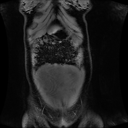 Normal MRI abdomen in pregnancy (Radiopaedia 88001-104541 M 34).jpg