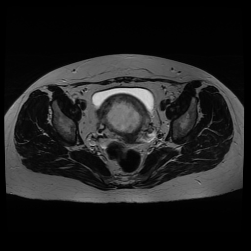 Normal MRI abdomen in pregnancy (Radiopaedia 88005-104548 Axial T2 31).jpg