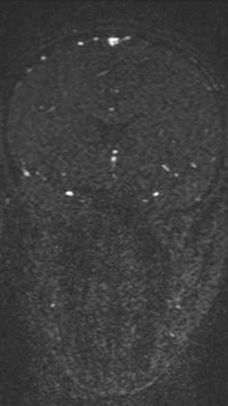 Normal MRI brain with MRV- teenager (Radiopaedia 49425-54553 Coronal MRV 97).jpg