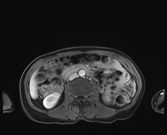 Normal adrenal glands MRI (Radiopaedia 82017-96004 K 49).jpg