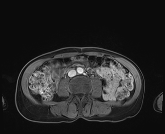 Normal adrenal glands MRI (Radiopaedia 82017-96004 K 62).jpg