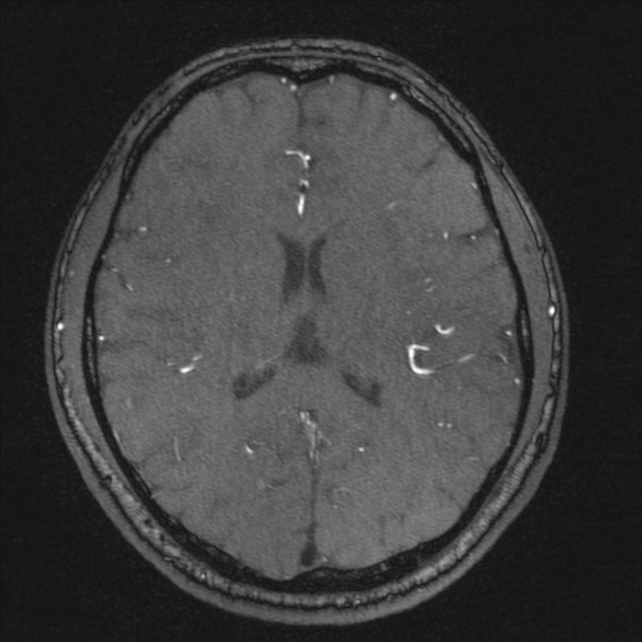 Normal brain MRI including MRA (Radiopaedia 48748-53763 Axial MRA 131).jpg