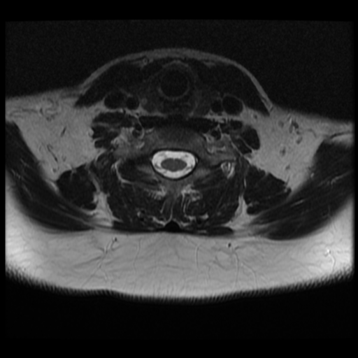 File:Normal cervical and thoracic spine MRI (Radiopaedia 35630-37156 Axial T2 12).png