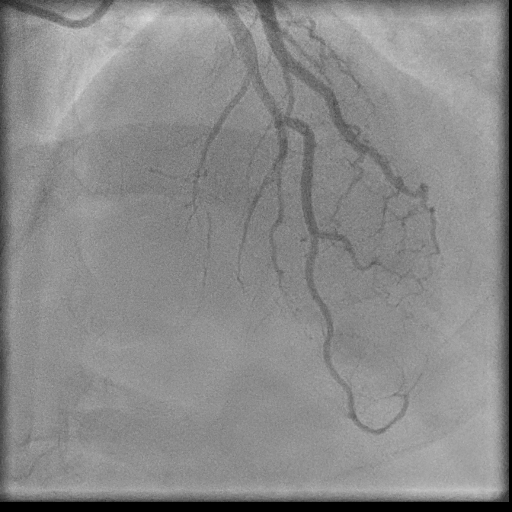 Normal coronary angiogram (DSA) (Radiopaedia 63081-71571 E 60).jpg