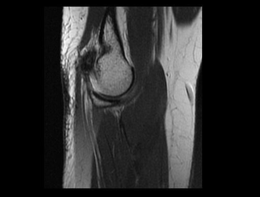 File:Normal elbow arthrograms (Radiopaedia 75550-86805 Sagittal PD 29).jpg