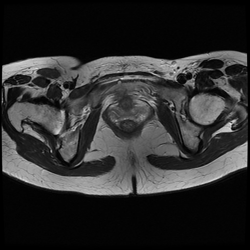 File:Normal female pelvis MRI (retroverted uterus) (Radiopaedia 61832-69933 Axial T2 24).jpg