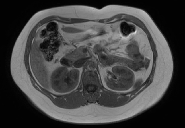File:Normal liver MRI with Gadolinium (Radiopaedia 58913-66163 Axial T1 in-phase 16).jpg